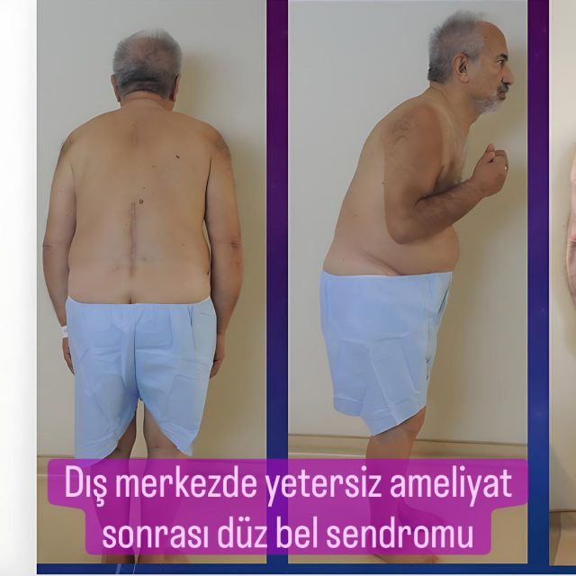 Altı yıl önce başka bir merkezde yapılmış yetersiz bir cerrahinin revizyon ameliyatını yapmıştım. Taburculuk sonrası sadece yarım kutu parol tablet kullandığını ve o günden beri beli veya sırtı ile ilgili herhangi bir ağrı kesici kullanmadığını ve şikayeti de olmadığını belirten hastamıza inanmak gerçekten güç.

Bazı hastaların inanılmaz hızlı iyileşmeleri karşısında bazen sadece hayret etmek ve şükretmek gerekir.

Dünyadaki en iyi merkezlerde dahi erişkin omurga deformite cerrahisinin komplikasyon oranının %20 olduğunu unutmadan, asıl güvenmemiz gereken güncel teknik ve bilgileri daima tazeleyerek doğru yaptıklarımızdan dersler çıkartıp onları geliştirmektir. Bizi en çok eğiten ve büyütenler ise kendi hatalarımızla yüzleşip onları nasıl çözeceğimize odaklanmaktır. 👊🏻👊🏻👊🏻

#scoliosis 
#skolyoz 
#love 
#carpentary 
#spine 
#omurgasağlığı 
#belağrısı 
#profdrsinankahraman