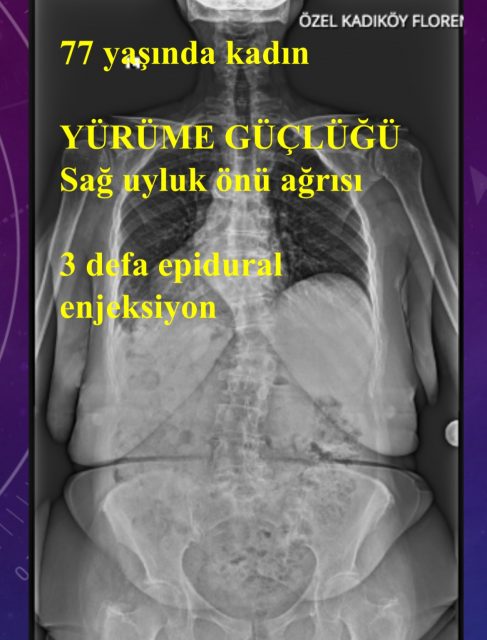 Hastanın muayenesi esastır
Gerekli zaman ve özen verilmelidir 
Filmler değil hasta tedavi edilmelidir 
Her skolyoz ve bel fıtığı 
ameliyatlık değildir

#skolyoz 
#omurgasağlığı 
#protez 
#ortopedi 
#muayene