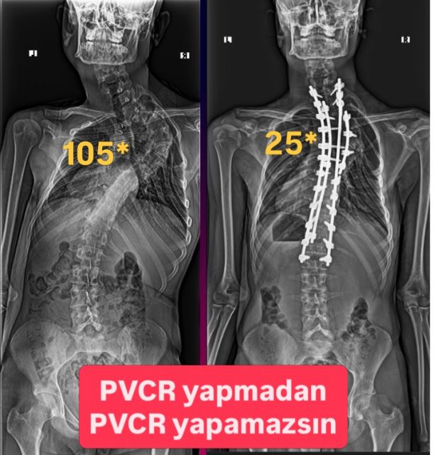 This is not a routine case.
This is high-risk, high-precision deformity surgery.
1️⃣ 🎯 Control starts with planning
C7–L1 instrumentation → take global control
2️⃣ 🦴 Release the deformity
Asymmetric rib resection (4 left / 2 right)
3️⃣ 🧠 Protect the spinal cord
Wide laminectomy above & below PVCR level
4️⃣ 🛠 Never lose stability
Temporary rod = controlled release 
5️⃣ ❌ Remove the keystone
Apical vertebral resection (PVCR) with patience
6️⃣ 🔻 Convex side compression is the key for relaxing cord, concave side pediclectomy is mandatory for type 3 spinal cord shape.
Controlled compression to close the curve
7️⃣ 🔺 Concave side patience
Gradual translation with reduction screws
8️⃣ 🧱 Rebuild the anterior column
Cage + graft = long-term stability
9️⃣ 📈 Respect physiology
MAP > 90 | Hb > 10 → non-negotiable
🔟 ⚖️ True success
Not just coronal correction → restore sagittal balance

💬 Take-home message:
Severe deformities are not corrected by force…
but by strategy, patience, and respect for biology. 

#scoliosis #spinesurgery #spinedeformity #orthopedicsurgery #profdrsinankahraman