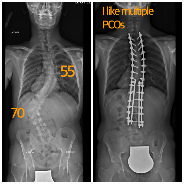 🇬🇧 PONTE OSTEOTOMIES: THE CORNERSTONE OF MODERN SCOLIOSIS SURGERY
55° thoracic + 70° lumbar scoliosis.
In large and rigid deformities, implants alone do not create correction. Before the spine can be realigned, it must first be mobilized. This is why Ponte osteotomies have become the workhorse osteotomy of modern scoliosis surgery.
🔥 1. The fundamental osteotomy of scoliosis correction.
One of the most widely used posterior release techniques in spinal deformity surgery worldwide.
✂️ 2. Creates a complete disconnection of the posterior elements.
By releasing the posterior tension band, rigid spinal segments become mobile and correctable.
📈 3. Provides approximately 5–10° of correction per level.
When performed at multiple levels, the cumulative corrective effect can be remarkable.
📏 4. Improves both coronal and sagittal alignment.
Not only straightens the spine but also helps restore physiological spinal contours.
🌪️ 5. Facilitates rotational correction.
Addresses the three-dimensional nature of scoliosis and improves trunk symmetry.
🦴 6. Converts a rigid spine into a flexible construct.
Allows corrective forces from rods and screws to be transmitted far more effectively.
🚀 7. Should not be avoided in severe and stiff deformities.
When indicated, it is one of the most powerful and versatile tools available to the deformity surgeon.
⚖️ 8. Helps achieve a more balanced and physiological spine.
The goal is not simply a straighter spine—but a better-aligned spine.
🛡️ 9. Associated with a very low complication rate.
In experienced hands, Ponte osteotomies are safe, reproducible, and highly effective.
👨⚕️ 10. The hidden force behind major corrections.
Patients see the rods and screws. Deformity surgeons know that the correction often begins with the osteotomies.
🔥 Final Thought
"Great scoliosis corrections are not achieved by forcing the spine into position, but by first giving a RELEASE!!!."
#scoliosis
#skolyoz
#kifoz
#omurgasağlığı
#profdrsinankahraman