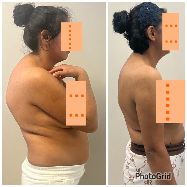 Not Every Kyphosis Should Be Corrected the Same Way

Successful kyphosis surgery is not about achieving the maximum correction—it is about achieving the safest correction for the individual spinal cord.

🧠 1. Continuous Intraoperative Neuromonitoring
Motor Evoked Potentials (MEPs) and Somatosensory Evoked Potentials (SSEPs) are monitored throughout the procedure. Even subtle signal changes can indicate spinal cord stress and immediately influence our surgical strategy.

📐 2. The Amount of Correction Must Be Individualized
The goal is not to create the straightest spine possible, but to restore optimal sagittal alignment while respecting the neurological limits of each patient.

🧬 3. Spinal Cord Morphology Matters
Patients with Lenke Type 3 spinal cord morphology often have a more vulnerable spinal cord at the apex of the kyphosis. In these cases, the correction strategy should be tailored to the spinal cord rather than the deformity alone.

⚠️ 4. Neuromonitoring Guides Every Critical Decision
If neuromonitoring signals deteriorate, correction may be reduced, instrumentation adjusted, spinal cord perfusion optimized, or additional decompression performed. Patient safety always takes priority over radiographic perfection.

🏆 5. A Successful Operation Means More Than a Beautiful X-ray
The true success of kyphosis surgery is a balanced spine, preserved neurological function, and a patient who wakes up safely with improved posture and quality of life.

“The best correction is not the maximum correction—it is the safest correction for that patient’s spinal cord.”