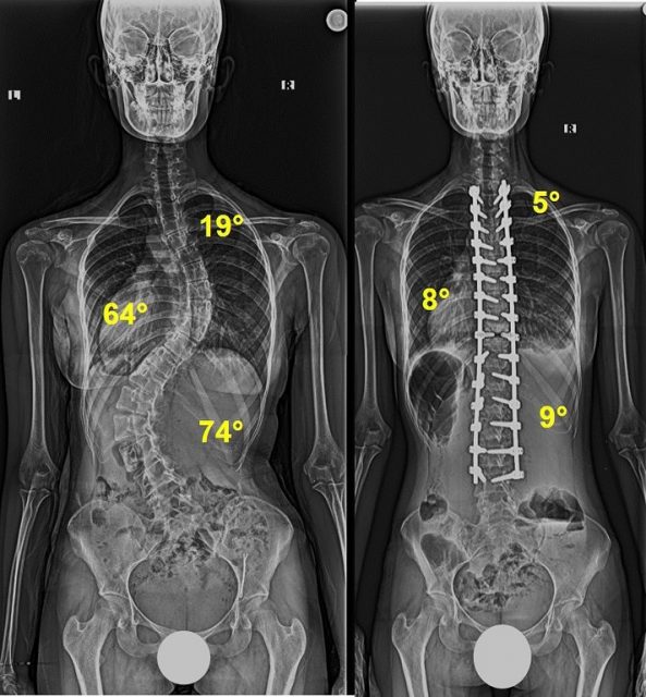 Skolyoz ameliyatlarında her eğrilik ve her hasta için farklı teknikler uygulanabilir. Oldukça sert çift major eğriliği olan hastadaki düzeltme manevraları :

1- Öncelikle sagittal planı düzelt! 
Bu hastada sadece skolyoz sorunu yoktu, aynı zamanda akciğerlerin yeterince şişmesini engelleyen torasik hipokifoz mevcuttu. Fizyolojik kifozu restore etmek için 10 seviye Posterior kolon osteotomisi yapıldı. Sol taraflı İlk rod torakal bölgede hiperkifotik, torakolomber bölgede düzdü; hem torasik kifoz restore edildi hem de lomber taraftaki hump karşı tarafa itilmiş oldu. 

2- Sağ taraftaki ikinci rod proksimal torasik hariç, neredeyse düz bir rod olarak konuldu. Düz rod Torakal bölgede humpı azalttı, fizyolojik kifotik şeklini aldı ve konkav lomber bölgeyi kendine doğru çekti.

3- Son olarak ameliyat esnasında röntgen kontrolü yapıldı ve ince ayarlar (kompresyon ve distraksiyon) yapılarak hem sagittal hem koronal planda optimal bir sonuca ulaşıldı. 

4- Skolyoz sadece karşıdan bakıştaki omurga eğriği değildir. Sagittal plan mutlaka ve öncelikle düzeltilmelidir. Koronal plan ikinci sırada düzeltilir, aksiyel plan en son ince ayarlar yapılırken düzeltilir.

1️⃣Bu içerik bilgilendirme amaçlıdır
2️⃣Paylaşımdaki bilgiler tıbbi muayene ve tedavinin yerini tutmaz
3️⃣Kişiye özel tanı ve tedaviler için Ortopedi ve Travmatoloji Uzmanına başvurunuz

#skolyoz 
#scoliosis 
#kyphosis 
#kifoz 
#love 
#workshop 
#carpentry 
#profdrsinankahraman