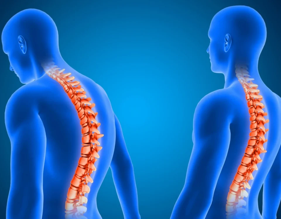 Skolyoz Nedir? Belirtileri, Tedavisi ve Ameliyat Süreci 8 Prof. Dr. Sinan Kahraman