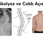 Skolyoz Dereceleri Cobb Açısı