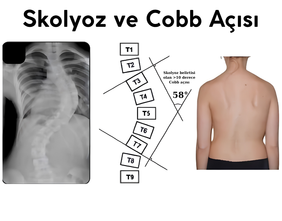 Skolyoz Dereceleri Cobb Açısı