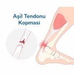 Aşil Kopması Nedir 5 Prof. Dr. Sinan Kahraman