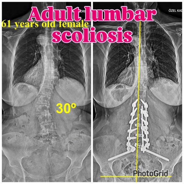 Adult Degenerative Lumbar Scoliosis — Correction Step by Step

🔎 Start with the problem.
A 61-year-old patient with adult degenerative lumbar scoliosis. The goal is to restore function, balance, and decompression of neural elements.

🧠 First, treat the neurology.
Address the symptomatic stenotic levels with adequate decompression and interbody reconstruction. Neural decompression comes before deformity correction.

📐 Then rebuild the sagittal profile.
Restore segmental lordosis where it matters most — particularly at L4–S1. In this case, distal lordosis improved from 25° to 40° with a PI of 50°.

➡️ Sagittal first, coronal second.
Once the distal lumbar foundation is restored, complete the sagittal correction before focusing on the coronal deformity. Alignment is a sequence, not a single maneuver.

↔️ Now correct the coronal plane.
Use asymmetric forces deliberately: distraction on the concavity and compression on the convexity to translate and derotate the lumbar curve while maintaining the sagittal correction already achieved.

⚖️ Never sacrifice one plane to correct another.
Coronal correction should complement — not destroy — the reconstructed lumbar lordosis. The objective is a balanced three-dimensional spine, not merely a straight AP X-ray.

✅ Final X-ray. Final check. Then leave the OR.
Before leaving the operating room, verify coronal balance, sagittal alignment, pelvic relationship, distal lordosis, and the overall construct. The operation is finished only when the planned alignment is actually achieved.

🧠 Treat the neurology → 📐 Restore L4–S1 lordosis → ➡️ Correct sagittal alignment → ↔️ Correct coronal deformity → ✅ Confirm global balance.

Adult spinal deformity surgery is about restoring balance — in the right order. 👊🏻