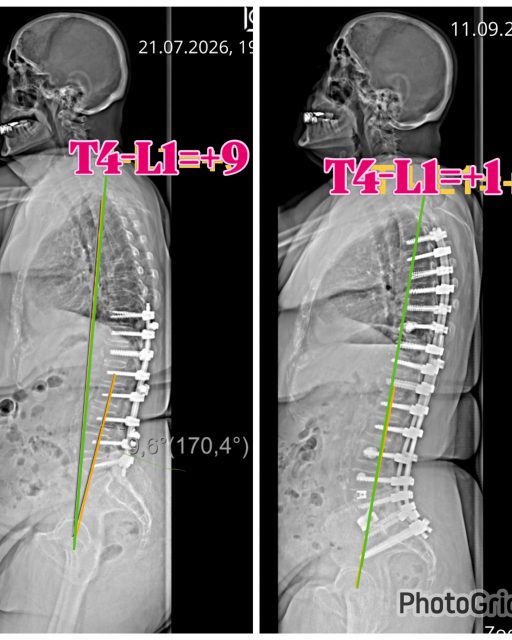 Dejeneratif ve erişkin omurga deformiteli hastaların sagittal dengesini doğru kurallar ile düzeltmeden yapılan cerrahi girişimler ne yazık ki yüksek revizyon oranlarıyla sonuçlanırlar.

Koronal plan için kural basittir.
Kafayı pelvis üzerinde tut yeter. 

Sagittal plan içinse kurallar oldukça karmaşıktır ve her geçen yıl geçmiş kurallar neredeyse yeniden düzenlenip yazılır.

Tüm kuralları öğrenmek ve dünyadaki yeni  gelişmeleri takip etmek için bu sene Kasım ayında Antalya’da yapılacak olan Ulusal Ortopedi kongresine sizleri bekliyoruz. Unutmayın 5 Kasım çarşamba saat 15:30 👊🏻👊🏻👊🏻 totbid2026.org
@profdrmehmettezer @anatolianspine @doc.dr.sinacoskun @mbugrayaz @doc.dr.recepdincer @cobanoglumutlu @op.dr.huseyin.ozturk @doc.dr.bilgekaganyilmaz @profdrhalilatmaca @totbid2026 

#totbid2026 #sagittalplane #decompress #stabilize #realign