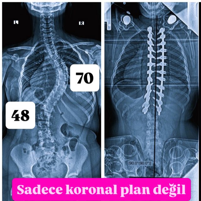 Adolesan Skolyoz cerrahisinde sagittal profilin planlanması

Çok sık karşılaştığımız örnek bir idiyopatik skolyoz vakası üzerinden, koronal düzelmenin yanında sagittal planlamada nelere dikkat ettiğimi paylaşmak istiyorum.

Rodları şekillendirirken şu noktalara odaklanıyorum:

• Önce hastanın pelvik insidansını (PI) değerlendiriyor, buradan hedef L1 pelvik açısını (L1PA) hesaplayarak hastaya özgü sagittal profili planlıyorum.

• Torakal kifozu hastanın genel morfolojisine uygun biçimde oluşturmayı amaçlıyorum. 20–30° lik minimum bir kifoz oluşturmayı amaçlıyorum. 
• Kifozun sadece açısına odaklanmadan, dağılımına ve apeksinin T6–T11 bölgesinde yer almasına da dikkat ediyorum.

• Ameliyat sırasında mutlaka radyografik kontrol yapıyorum. Genel sagittal konturla birlikte, T4PA’nın L1PA’dan yaklaşık 3–4° daha küçük olduğunu kontrol ediyorum.

Bu vakada ameliyat sonrası ölçümler: PI 56°, L1PA 9°, T4PA 6° ve T2–T12 kifozu 36°.

Benim için başarılı bir düzeltmenin temelinde, omurganın harmonik bir biçime kavuşturulması yer alıyor. Sagittal planlama, rodların şekillendirilmesinden ameliyat sırasındaki radyografik kontrole kadar her aşamaya yön veriyorum.

Ayrıca Avustralya’nın Sydney kentinde düzenlenen Scoliosis Research Society (SRS) toplantısında Prof.Brice Ilharreborde’nin bu konudaki sunumu oldukça didaktik ve bilgilendiriciydi. Sagittal planlamayı cerrahi uygulamaya aktaran sistematik yaklaşımını dinledim. srs.org sitesinden siz de bu sunumu mutlaka dinleyin.

#skolyoz #spine  #scoliosisresearchsociety #omurgasağlığı #kyphosis